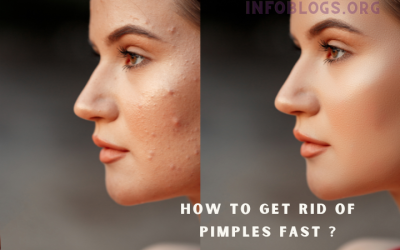 How to get rid of pimples fast ?