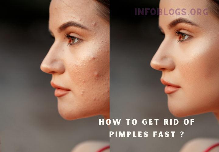 how to get rid of pimples fast